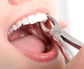 Удаление <br>зубов